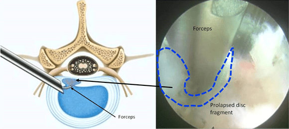 Endoscopic disc decompression procedure for slipped and herniated discs