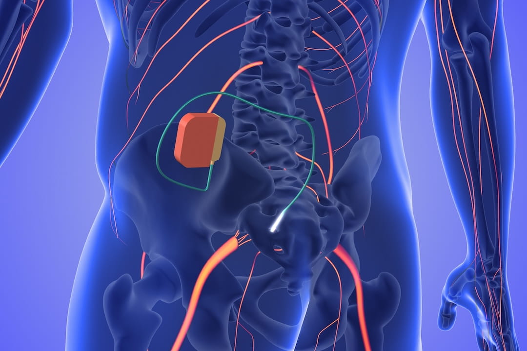 illustration for spinal cord stimulator