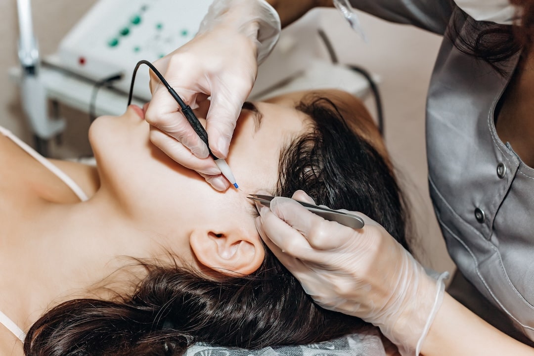 Trigeminal Ganglion Radiofrequency Rhizotomy